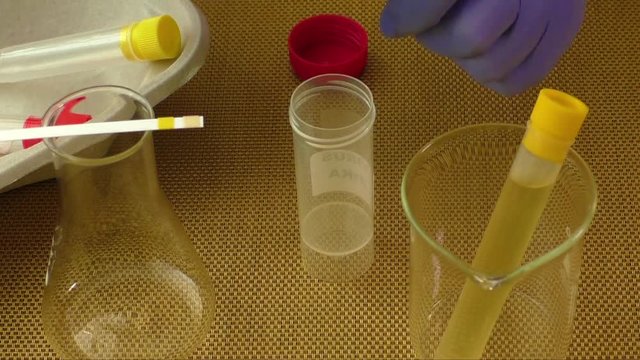 Container for urinalysis in the hand of the doctor
