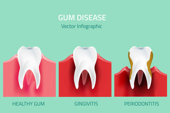 Gum Disease Stages. Teeth Infographic