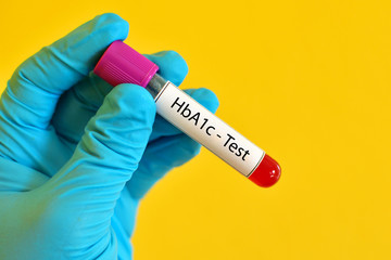 Obraz premium Hemoglobin A1c (HbA1c) test, diabetes diagnosis