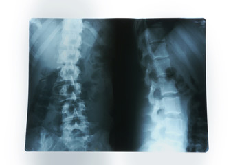 X-ray of human spinal column isolated on white