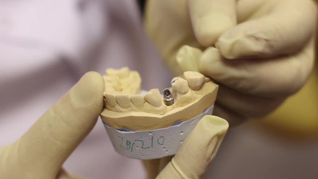 Example Of The Implant