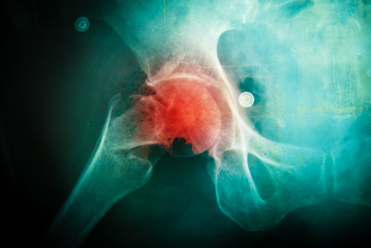 X-ray of the pelvis