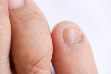 toenail