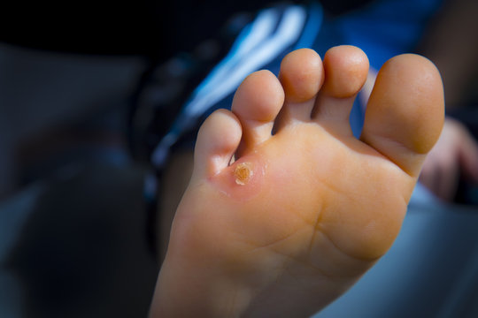 Calluses on foot