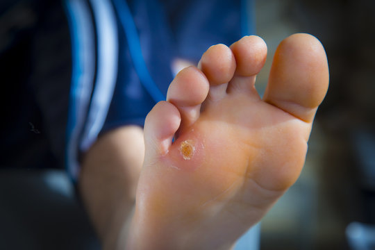 Calluses on foot