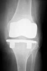 Knee injury surgical implant xray scan