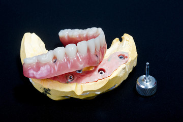 Prótesis dental completa sobre implantes  - 109763175