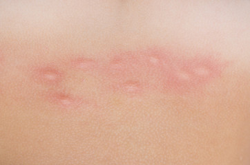 Obraz na płótnie Canvas mosquito bites on skin