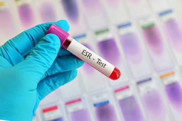 Blood sample for erythrocyte sedimentation rate (ESR) test
