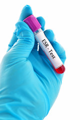 Fototapeta premium Blood sample for erythrocyte sedimentation rate (ESR) test 