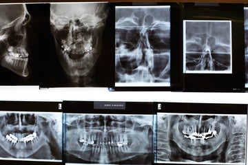 X-rays of the oral cavity