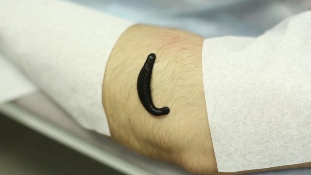 Hirudotherapy Leech On The Patient's Arm