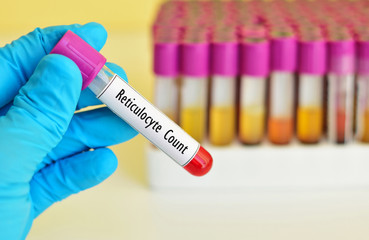 Naklejka premium Blood sample for reticulocyte count, immature red blood cell analysis 