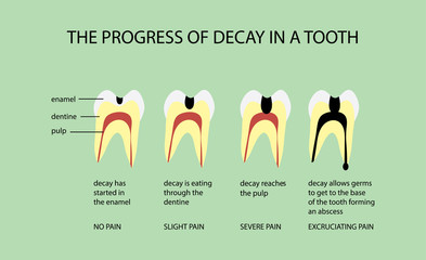 The Progress of Decay in a Tooth Diagram