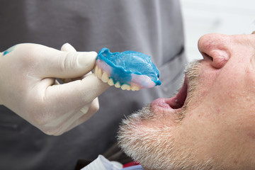 Repair of the upper jaw prosthesis insertion © 2707195204