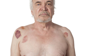 Treatment of people using vacuum therapy