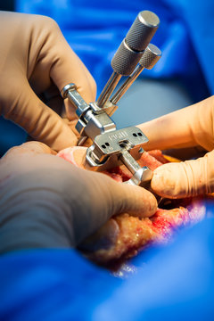 Measuring the distal femur