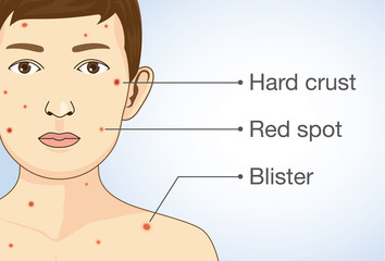 Diagram of the varicella infection in a child. The primary symptoms of chickenpox. Medical illustration.