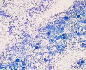 Cancer Cell in human showing abnormal cells.