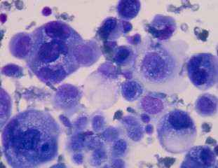 Cancer Cell in human showing abnormal cells.