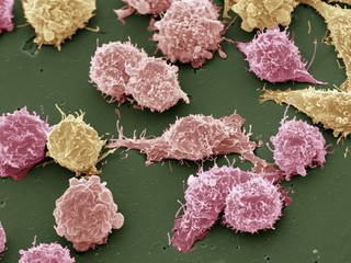 Cancer cells, SEM