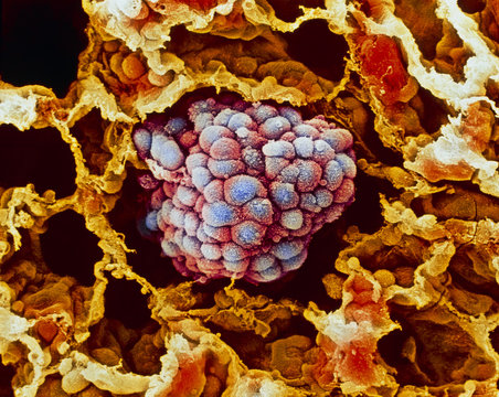 Coloured SEM of a cancerous tumour in the lung