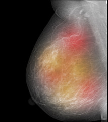 examining breast mastopathy or cancer