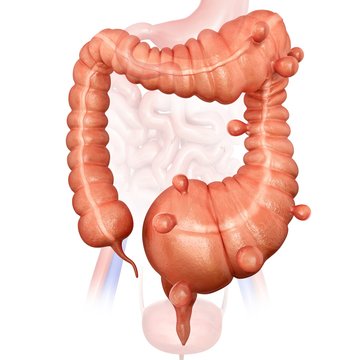 Megacolon and diverticulitis