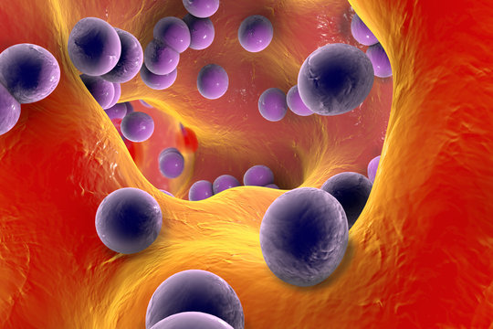 Staphylococcus infection, illustration