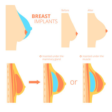 Breast augmentation infographics. 