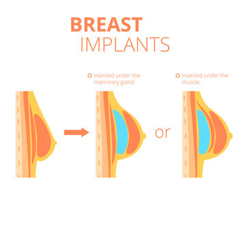 Breast augmentation infographics.