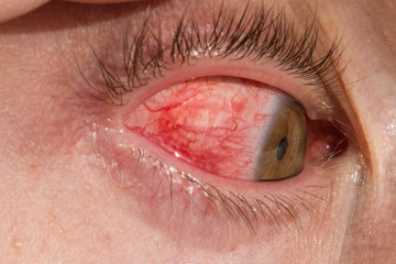 Inflamed Eye