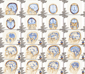 Magnetic resonance imaging of the brain with no visible abnormalities. 