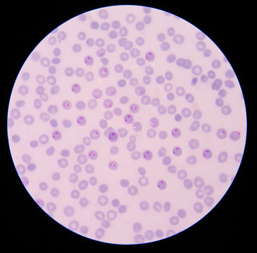 blood films for Malaria parasite