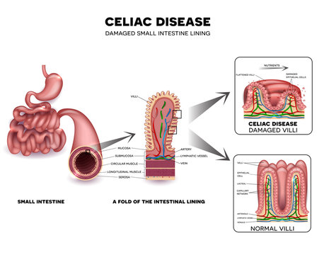 Celiac disease detailed anatomy, healthy intestinal villi and damaged unhealthy villi. Intestinal villi do not absorb nutrients because of reduced surface area.