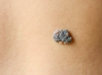 mole on the skin
