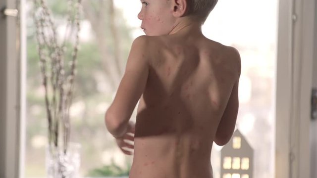 Chicken pox rash. A boy suffering from chicken pox rash scratching his back