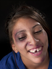 young woman with bruise on her face smiling.