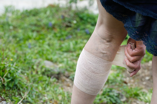 Woman with varicose veins applying compression bandage