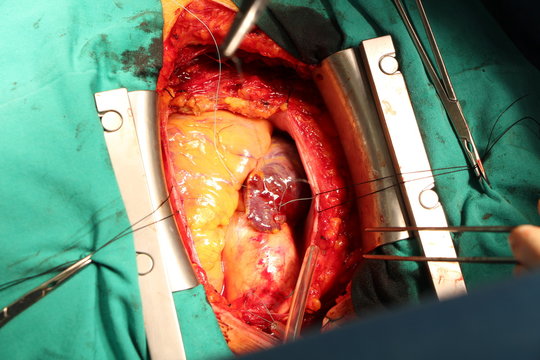 heart surgery