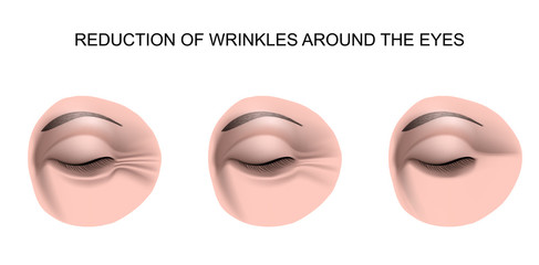 wrinkles around the eyes
