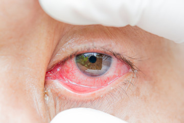 red bloodshot eye