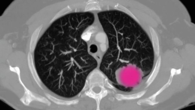 Animation of lung cancer