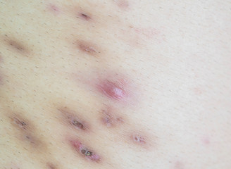 Closeup surface soft focus acne scars on back of body skin