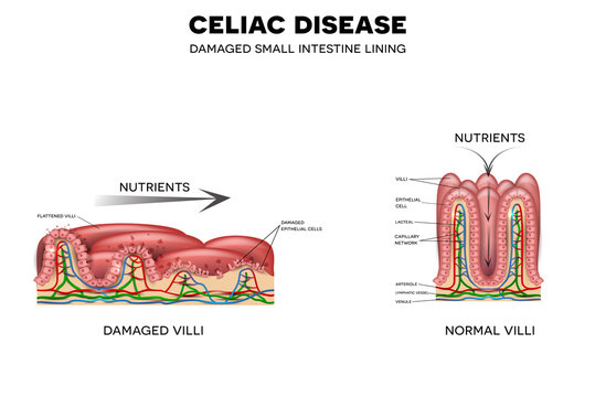 Celiac disease affected small intestine villi. Unhealthy villi with damaged cells and healthy villi. Intestinal villi do not absorb nutrients because of reduced surface area.