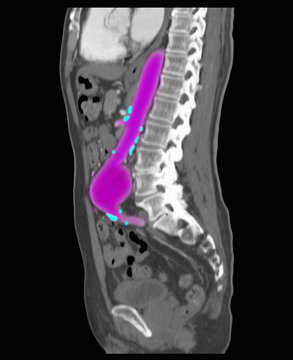 Abdominal angiographic CT scan showing a large abdominal aortic aneurysm (AAA).  Also seen are calcifications along the aorta and its branches which indicate atherosclerosis of the arteries