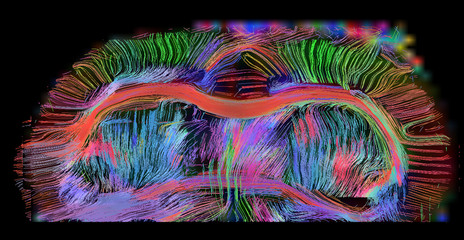 Axial view of rat brain connectivity. The corpus callosum is seen, anterior commisures and connections into the gray matter. Images are 300 microns