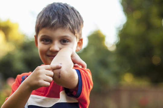 Boy pointing at bruise on elbow