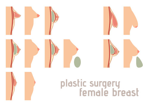 Breast augmentation infographics. Breast implants vector illustration