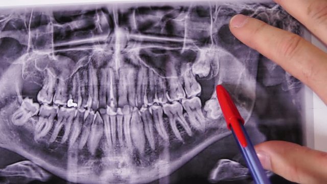 Close up shot of a dentist pointing out or indicating impacted wisdom teeth on the upper and lower jaw on a panoramic dental x-ray.